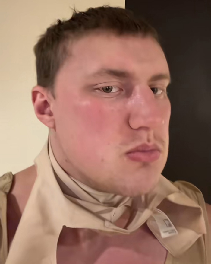 Man showing facial swelling likely after plastic surgery