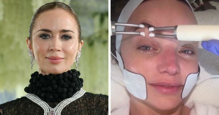 Met Gala 2026 Was More About Plastic Surgery Than Fashion As Stars Showed Off Their Procedures