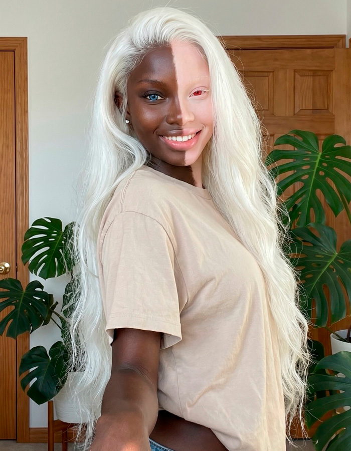 Model with strikingly unusual split skin coloration posing with long white hair