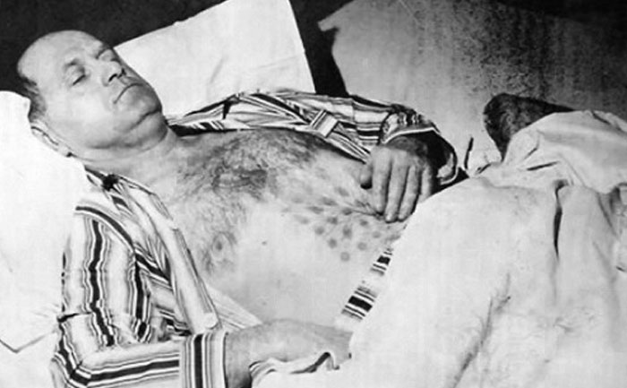 Man in hospital bed with strange circular marks on chest