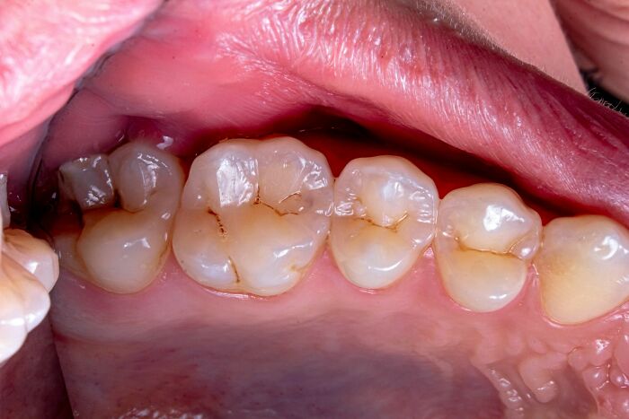 Close-up of human teeth with dental fillings and minor staining, illustrating concerning facts about dental health.