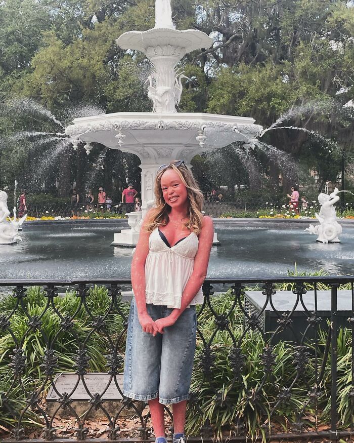Adolescente com problema de pele, sorrindo em frente a uma fonte branca com jatos de água, em um parque.