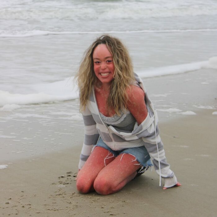 Adolescente com uma doença de pele rara, sorrindo na praia, vestindo moletom com capuz listrado e shorts jeans.