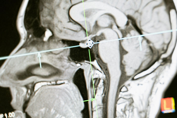 MRI brain scan with lines marking sections