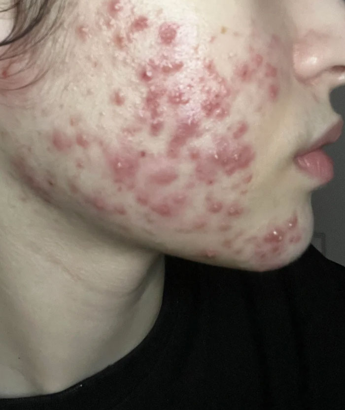 Severe acne on cheek illustrating beauty lies about skin perfection