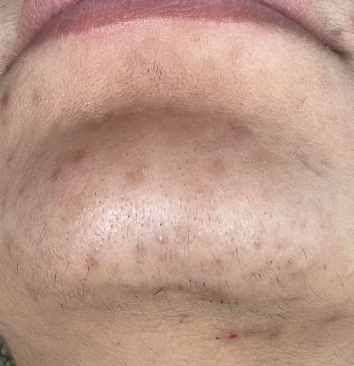 Closeup of chin with facial hair and blemishes highlighting beauty myths