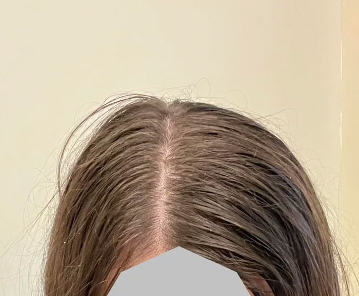 Woman's thinning hair and scalp revealing beauty lies about hair