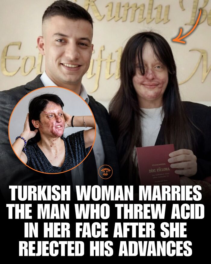Turkish woman marries man who threw acid in her face after rejection
