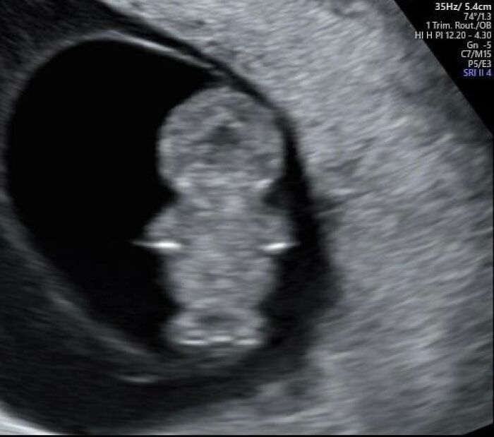 Ultrasound image resembling a figure inside womb with heart-like shape