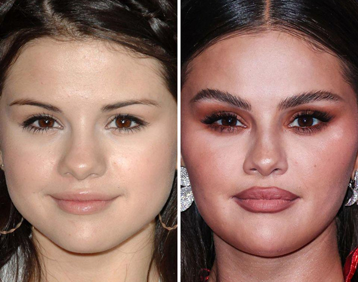 Celebrity before and after Botox and lip flip treatment face comparison