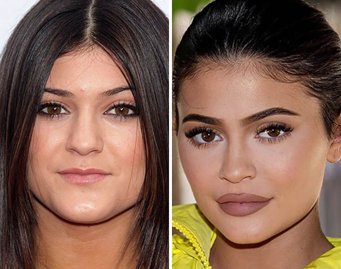 Celeb before and after Botox and lip flip transformation close-up portrait