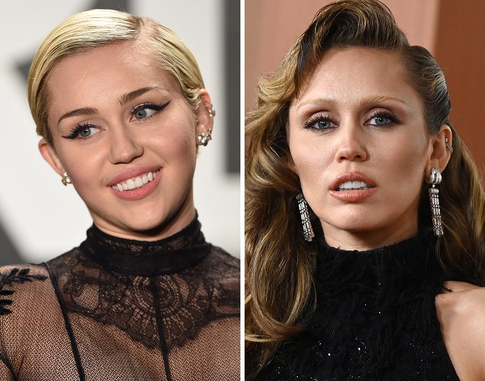 Side-by-side celeb photos before and after Botox and lip flip cosmetic changes