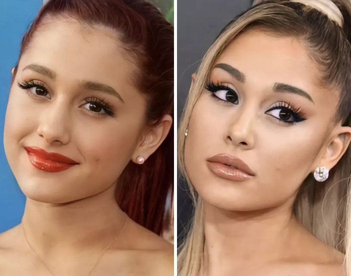 Before and after images of celebrity facial changes with botox and lip flip