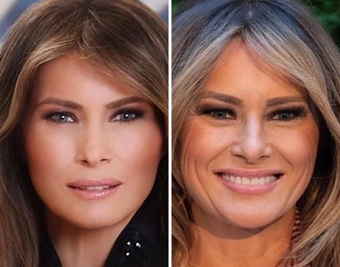 Before and after Botox and lip flip celeb transformation close-up photos