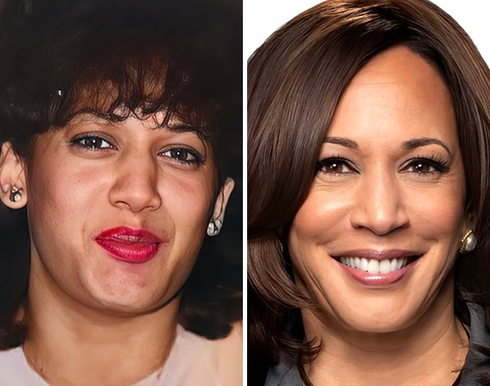 Before and after celeb Botox and lip flip transformation close-up photos