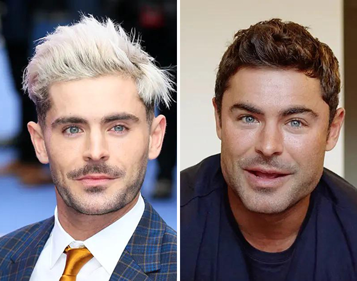 Side-by-side celeb before and after photos of botox and lip flip treatments