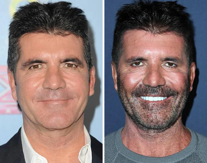Celebrity transformation photos highlighting botox and lip flip results