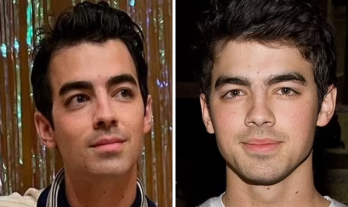 Celeb photos comparing botox effects and lip flip enhancements