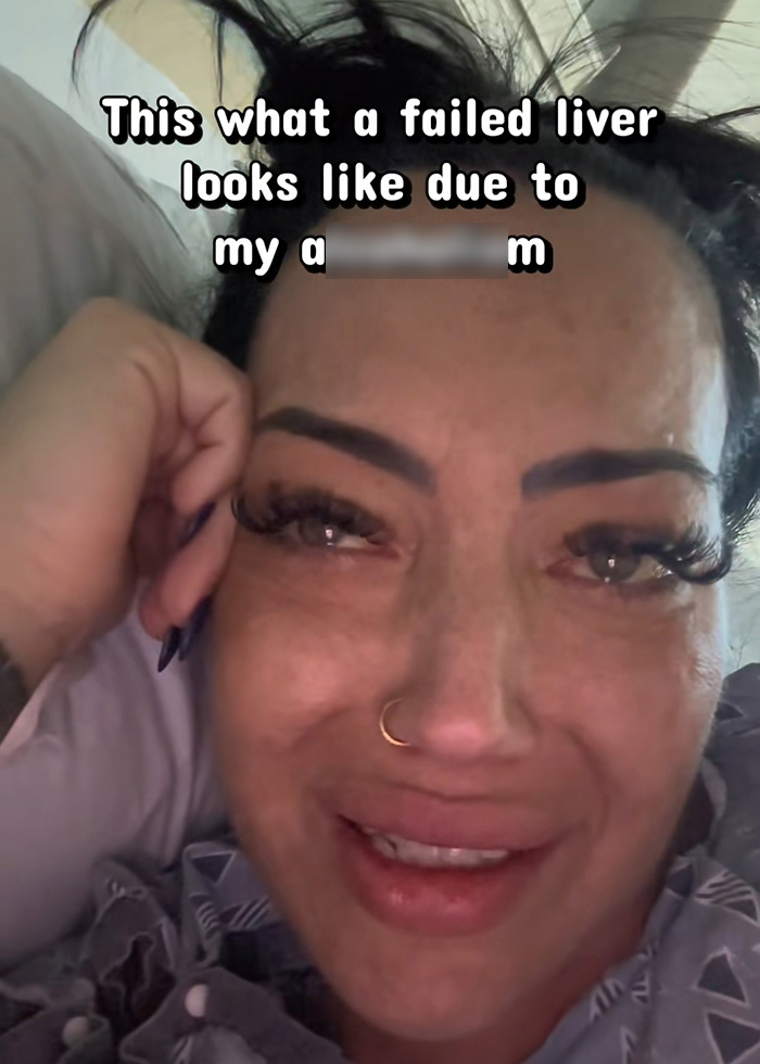 "Your Sign To Stop Now": Woman's Story Stuns As She Shares Experience With Liver Failure Due To Drinking