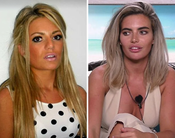 Celeb before and after Botox and lip flip procedure comparison images