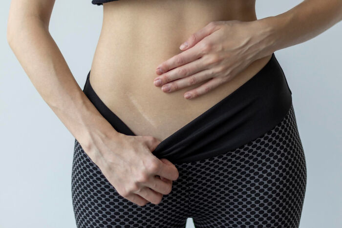 A person touching their abdomen, illustrating a solved medical mystery, with a visible scar on the skin.