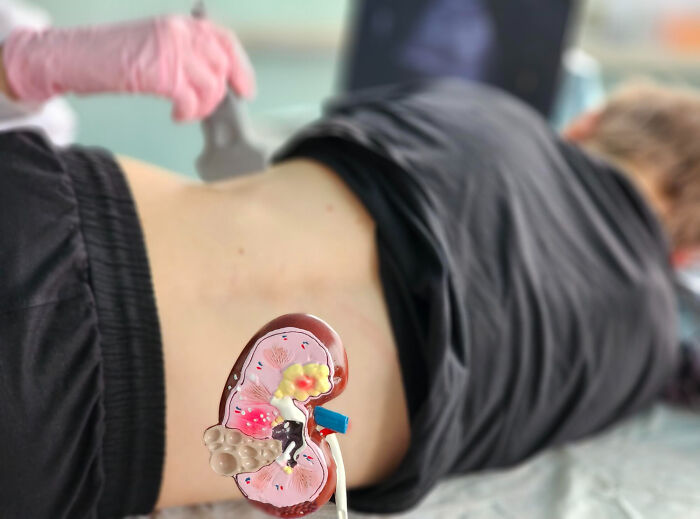 Ultrasound scan near kidney area on patient's back with kidney model, human body anatomy