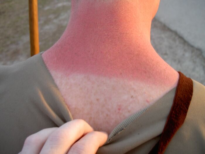 A person with a severe sunburn on their neck and shoulders, showcasing a type of pain from sun exposure.