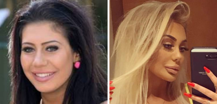 Before and after celeb photos showing changes from botox to lip flip treatments