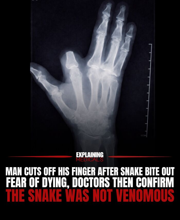 X-ray of a hand missing a finger amputated after snake bite fear