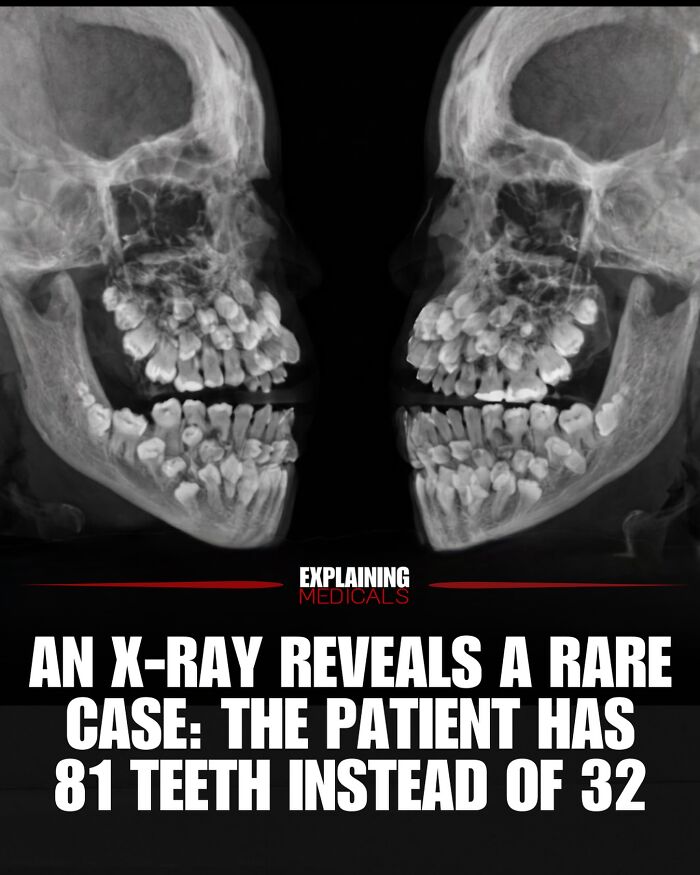 Dental X-ray revealing rare case of patient having 81 teeth instead of 32