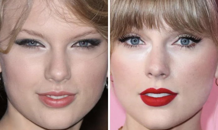 Before and after Botox and lip flip effects on celeb facial appearance