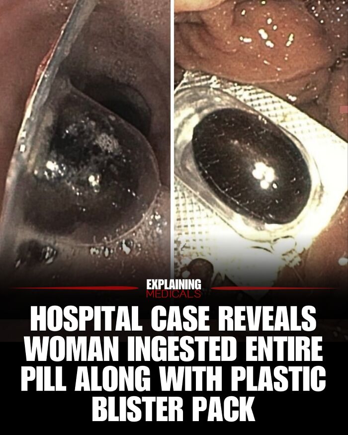 Endoscopic images showing a pill ingested with its plastic blister pack in a hospital case