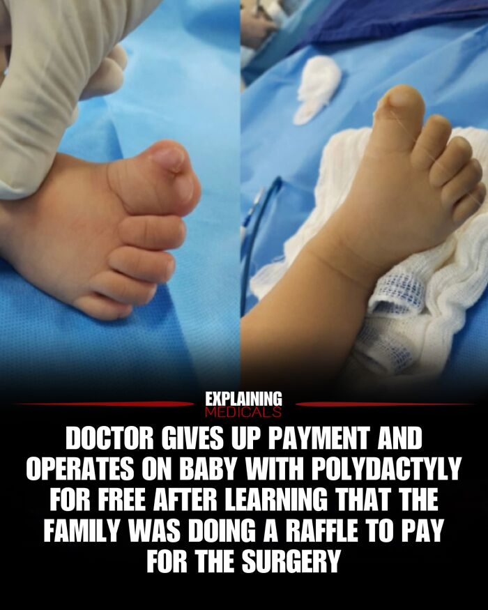 Doctor performs free polydactyly surgery on baby after family raffle news