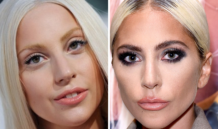 Celebrity transformations showing before and after Botox and lip flip treatments