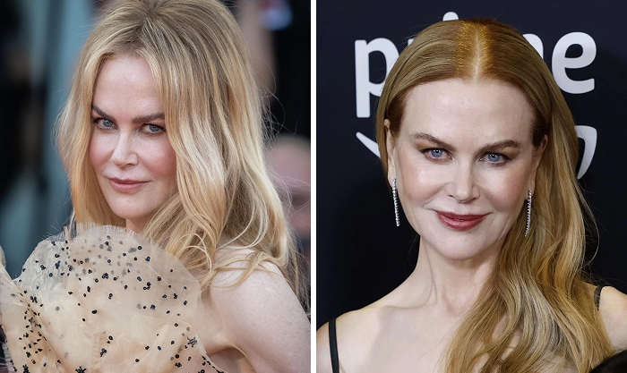 Celeb Botox and lip flip before and after transformation images