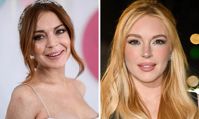 Before and after Botox and lip flip celeb face transformation photos