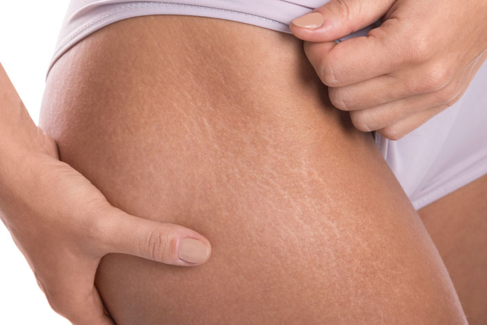 Close-up of woman's hip with stretch marks showing natural body
