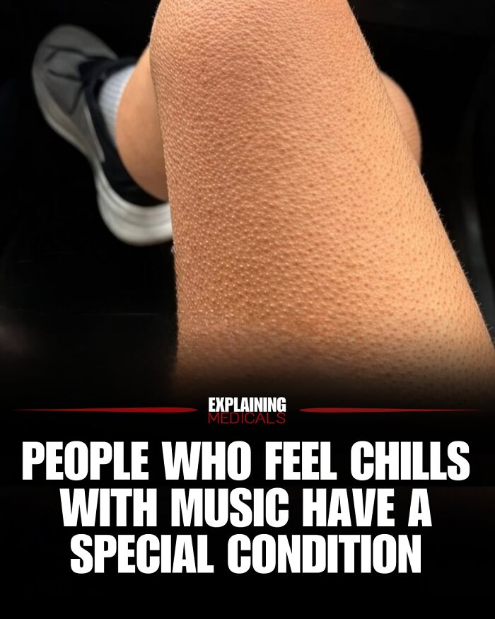 Close-up of skin with goosebumps linked to chills from music special condition