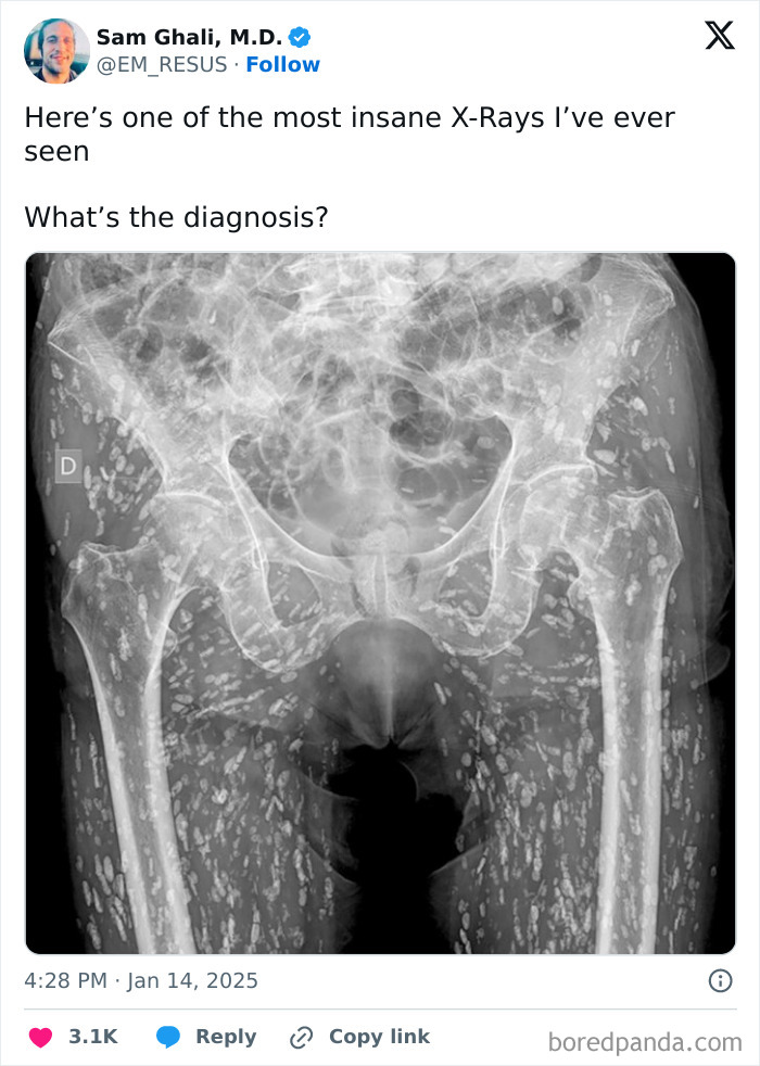 X-ray showing extreme human body quirk with dense calcification throughout pelvis and legs