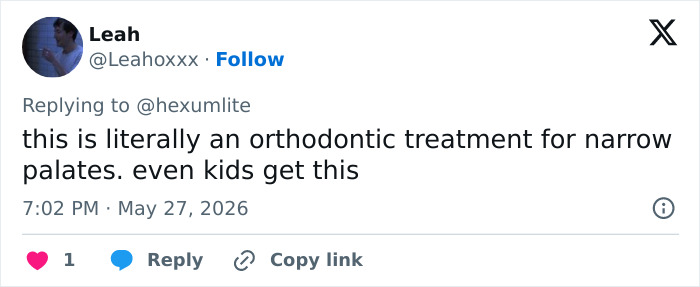 Orthodontic treatment for narrow palates linked to looksmaxxing discussed Orthodontic treatment for narrow palates linked to looksmaxxing discussed