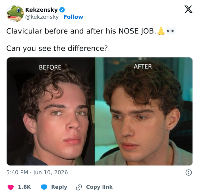 Before and after side-by-side comparison of clavicular's nose job Before and after side-by-side comparison of clavicular's nose job