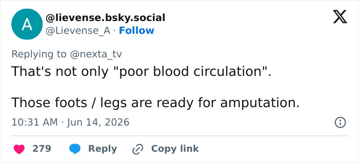 Netizen comment on social media about a man standing for over 5 years, highlighting poor blood circulation and amputation. Netizen comment on social media about a man standing for over 5 years, highlighting poor blood circulation and amputation.