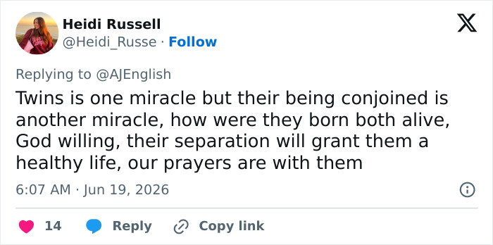 A Twitter post from Heidi Russell discussing the miracle of conjoined twins and wishing for their successful separation. A Twitter post from Heidi Russell discussing the miracle of conjoined twins and wishing for their successful separation.