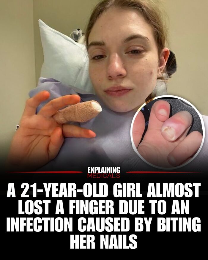 21-year-old girl almost lost finger due to nail biting infection medical story