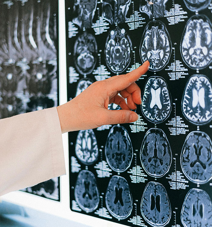 Doctor pointing at brain scan images related to postmenopausal brain-sapper Doctor pointing at brain scan images related to postmenopausal brain-sapper