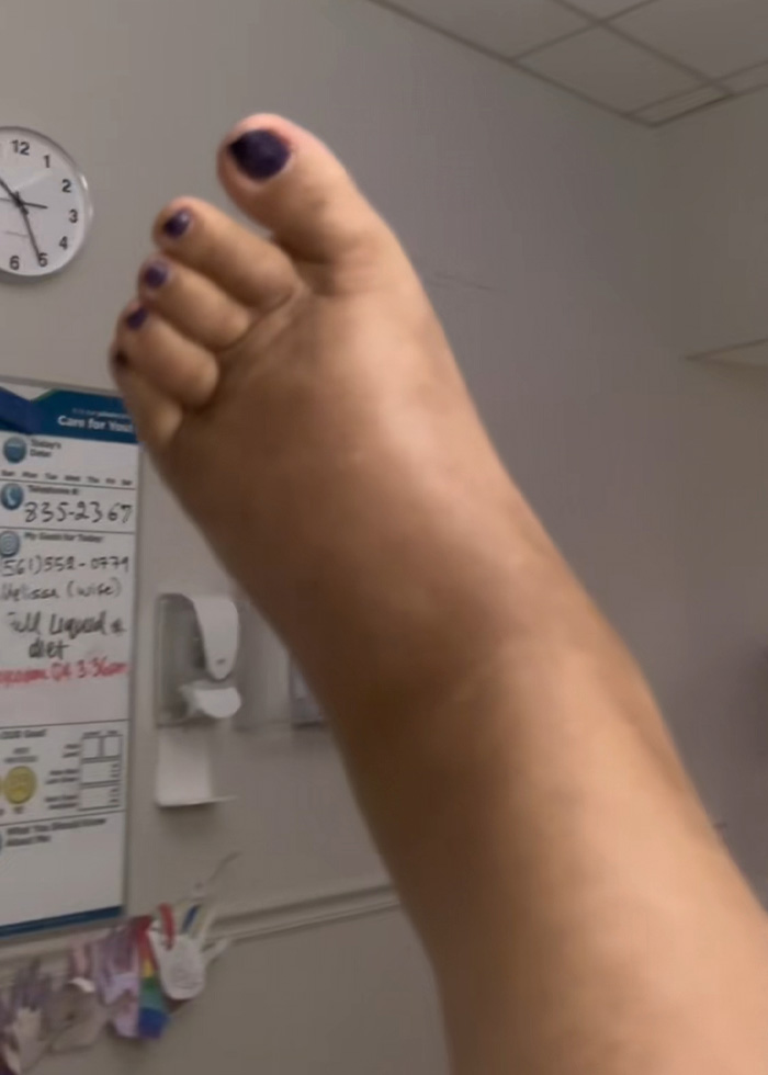 "Your Sign To Stop Now": Woman's Story Stuns As She Shares Experience With Liver Failure Due To Drinking