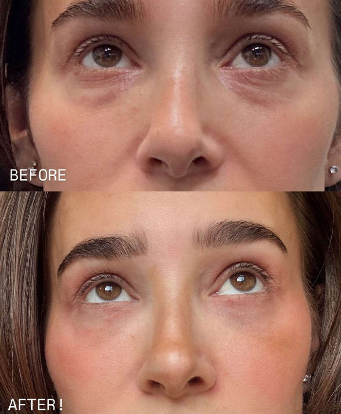 Before and after close-up of under-eye area showing improved skin after procedure
