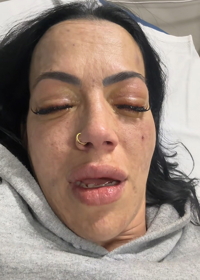 "Your Sign To Stop Now": Woman's Story Stuns As She Shares Experience With Liver Failure Due To Drinking