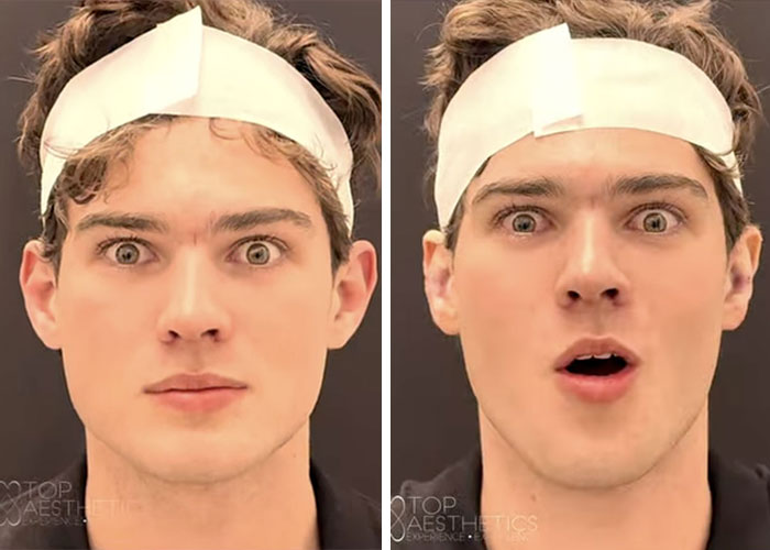 Before and after looksmaxxing side-by-side results on young man Before and after looksmaxxing side-by-side results on young man