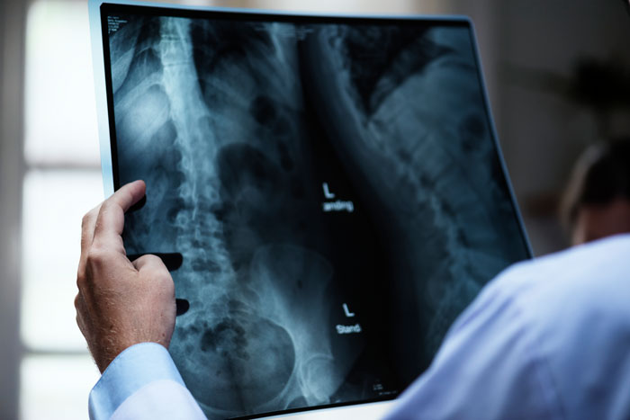 X-ray image showing a serious back injury relevant to girlfriend's broken back